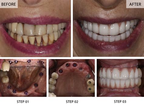 full-mouth implant in kent|Full Mouth Rehabilitation in Maidstone & Chatham .